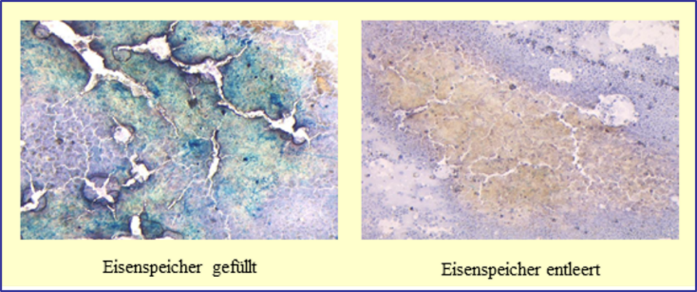 Berliner-Blau-Färbung des Knochenmarks