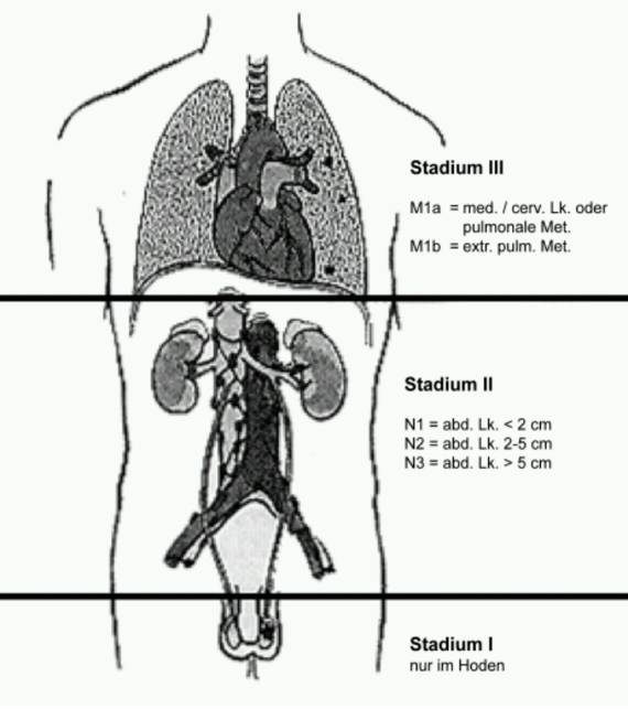 Tumorstadien
